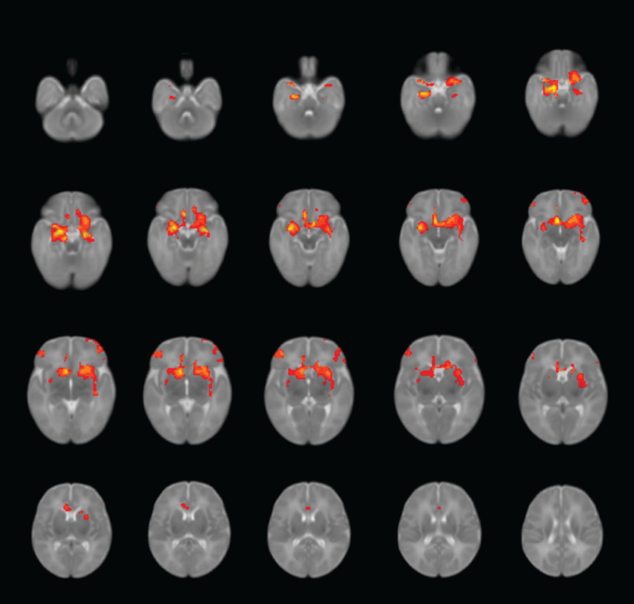 Los escáneres cerebrales muestran patrones de conectividad promedio entre la amígdala y otras regiones en los bebés.