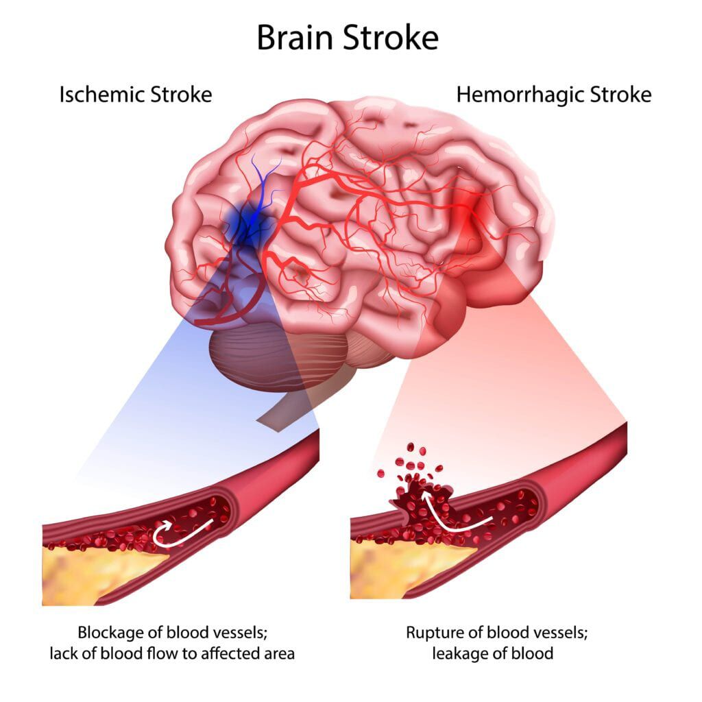 dos tipos principales de accidente cerebrovascular: isquémico y hemorrágico