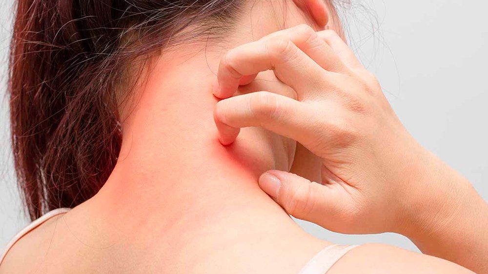 Cómo evitar pelar después de quemarse Cómo evitar pelar después de quemarse