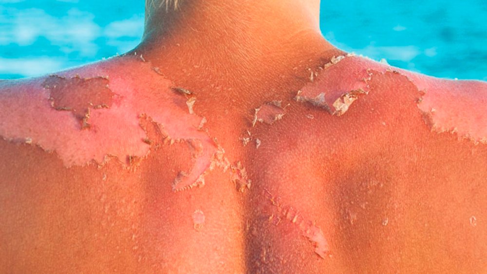 Cómo evitar pelar después de quemarse Cómo evitar pelar después de quemarse
